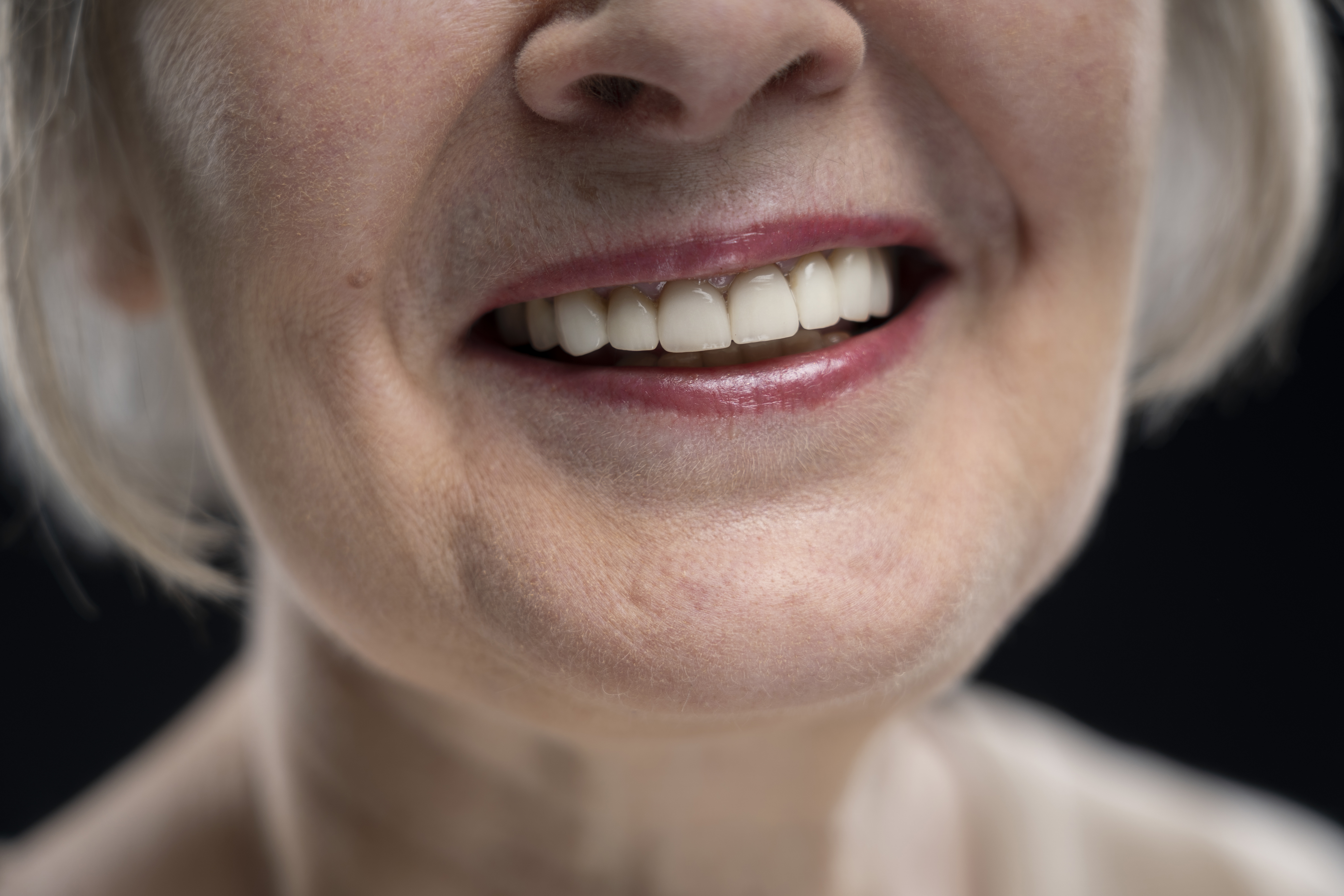 Caso de reabilitação oral — sorriso natural